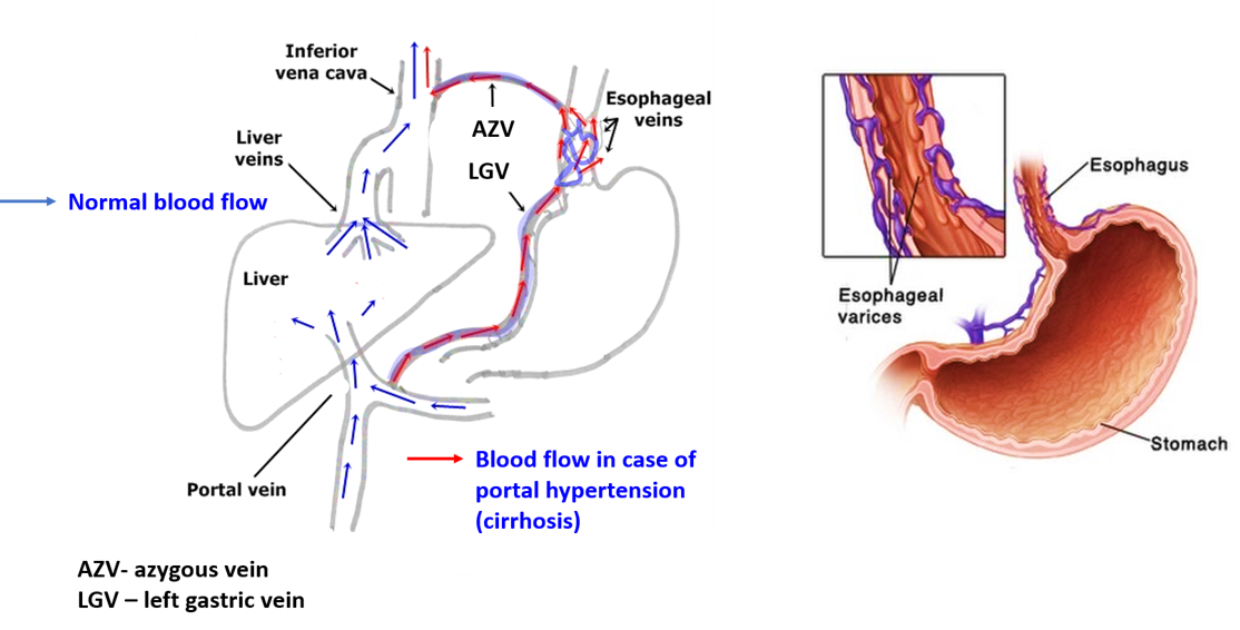 oesophageal varices