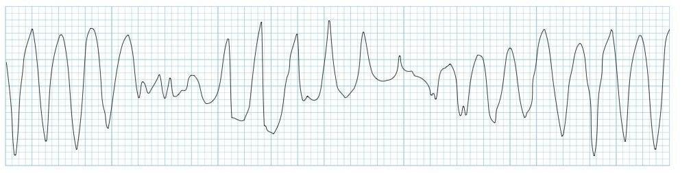 Polymorphic VT and Torsades de Pointes (TdP) • LITFL