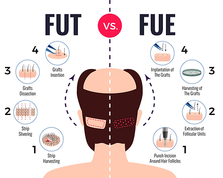 Difference Between FUT & FUE