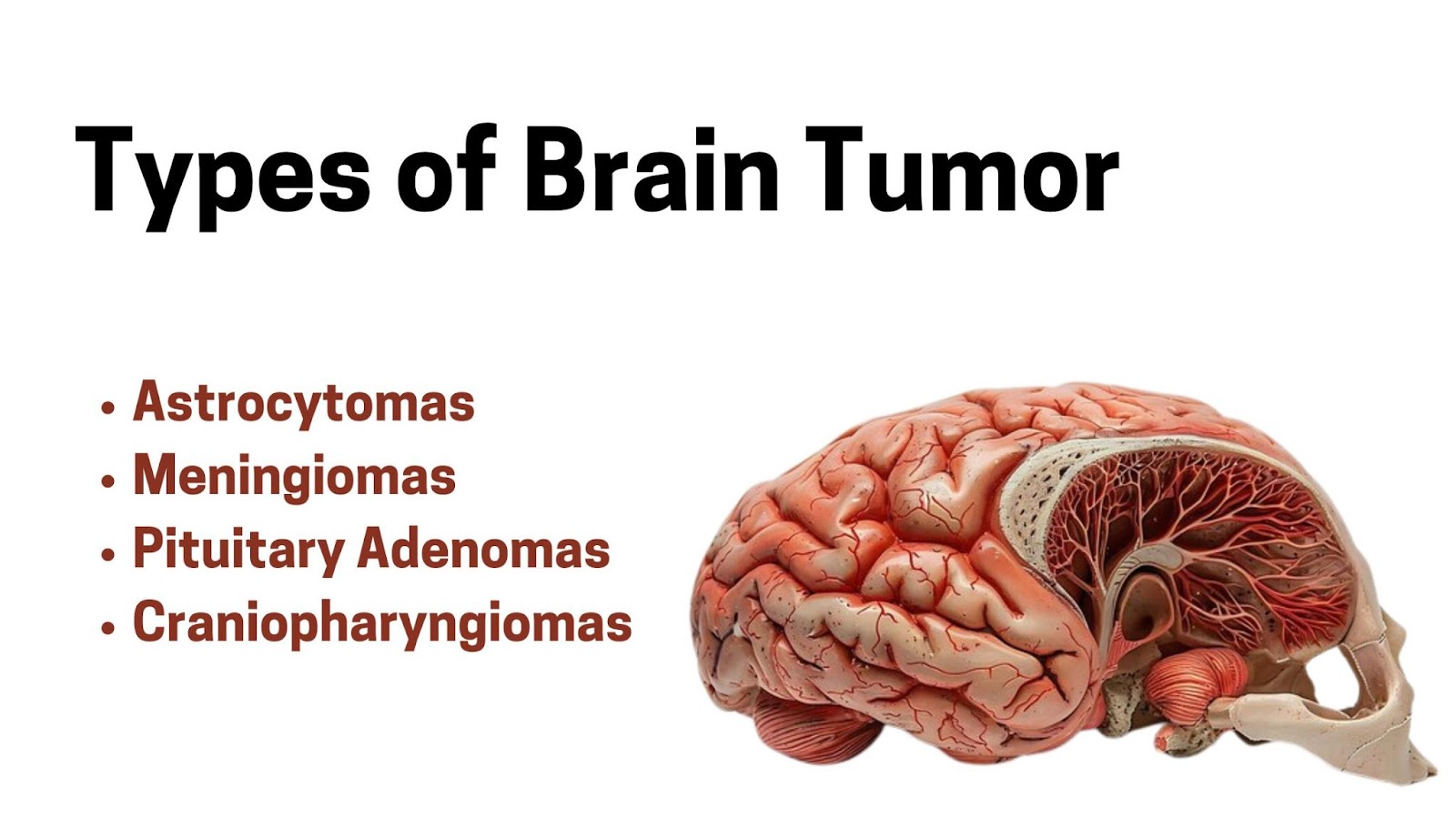 types of brain tumors