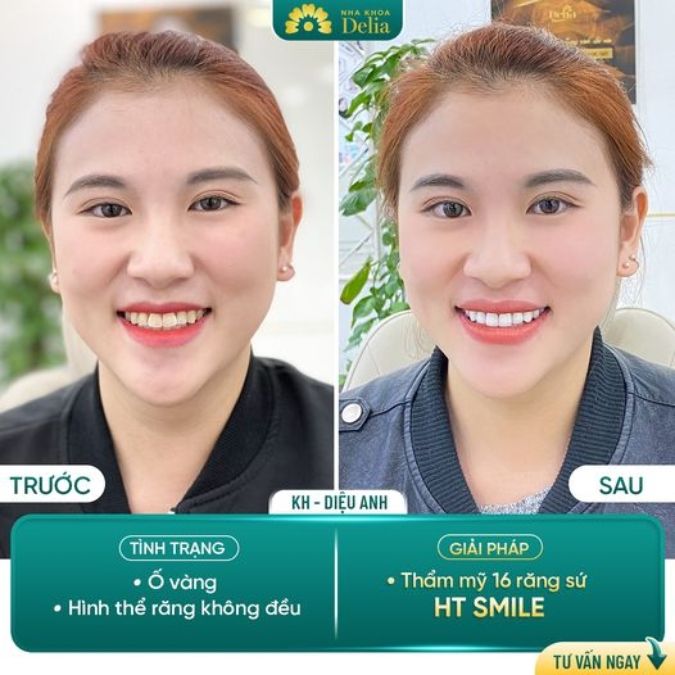 Răng sứ HT Smile