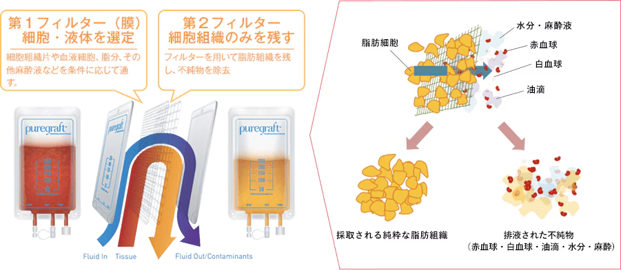 ピュアグラフト脂肪注入