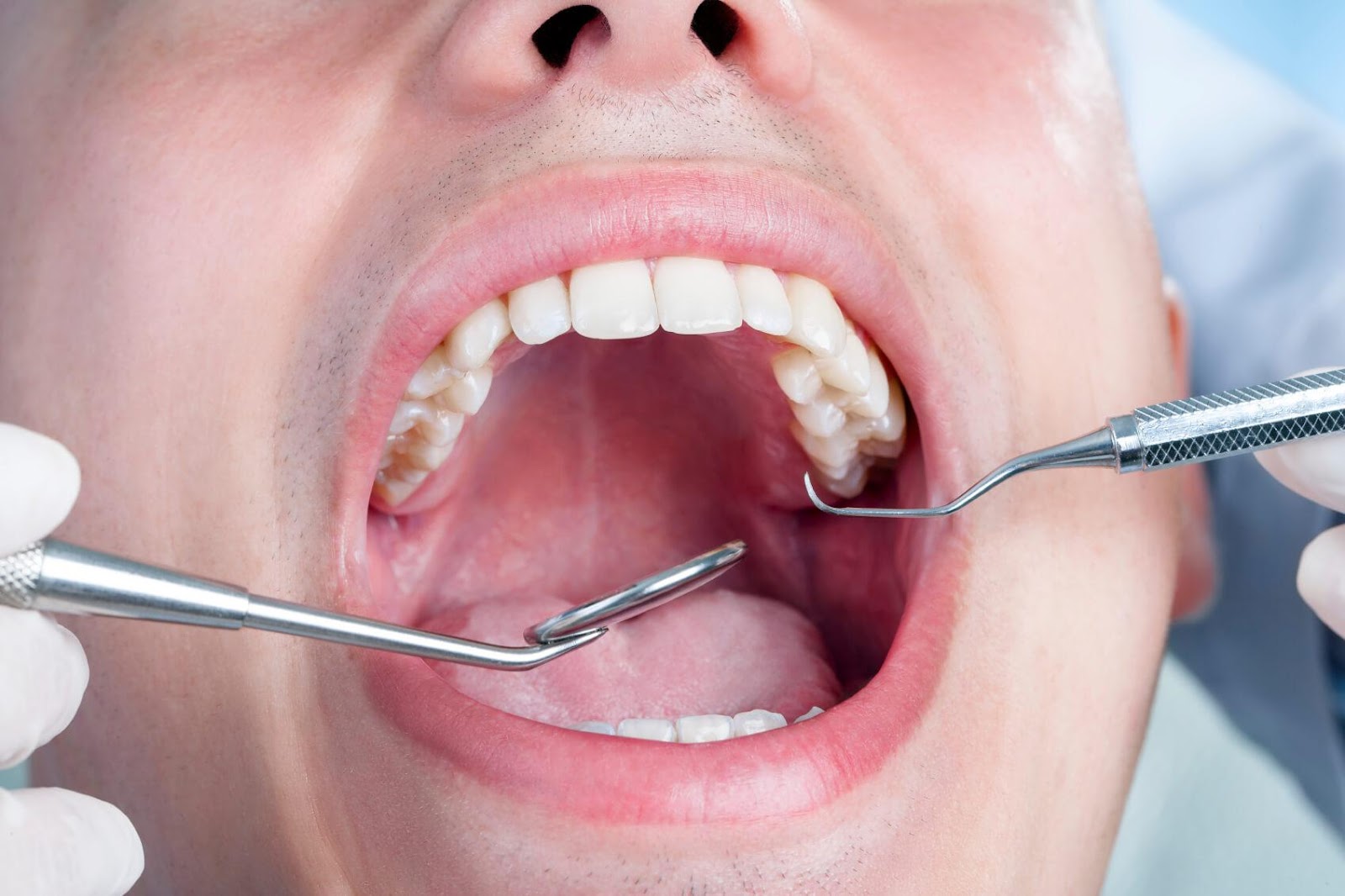 Wisdom teeth removal cost in Burnaby