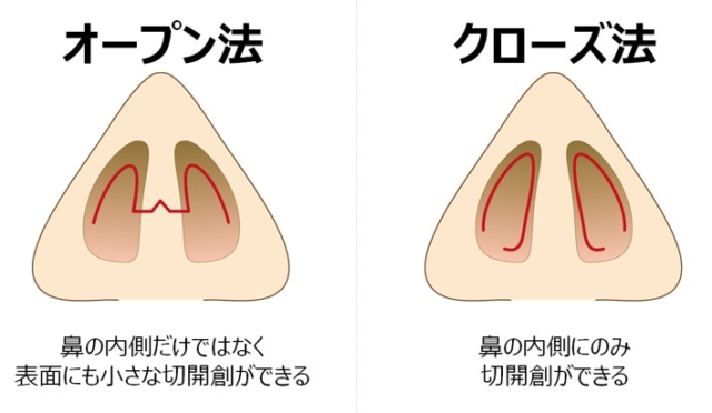 鼻尖形成の切開図