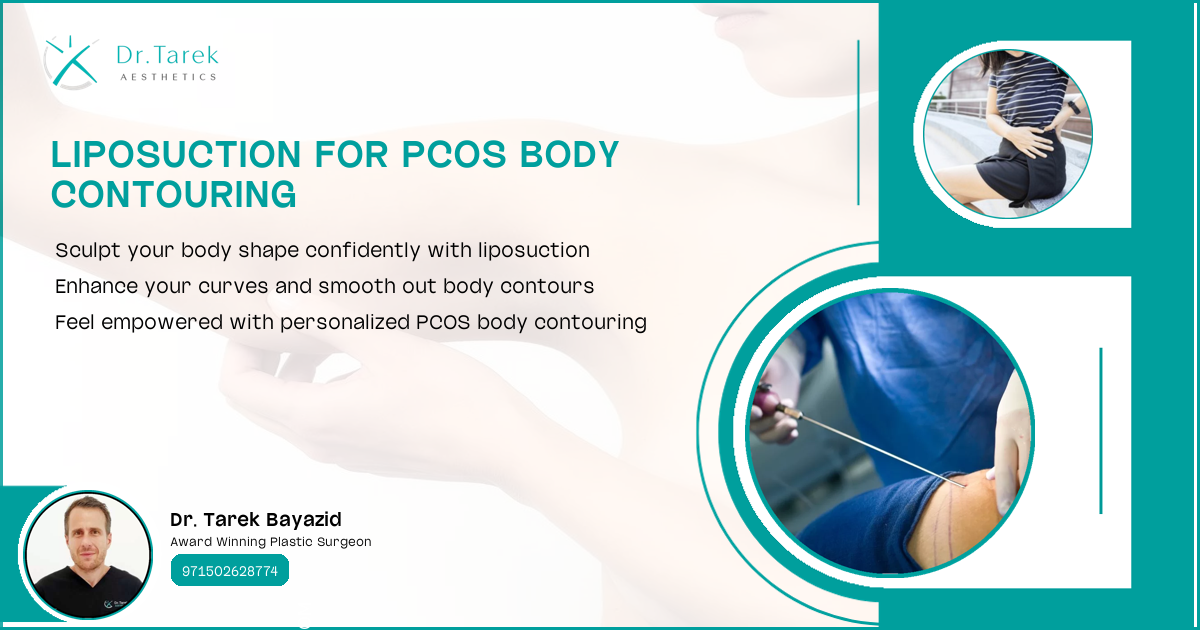 Can Liposuction Help Pcos