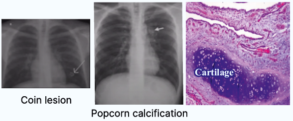 Lung Tumors