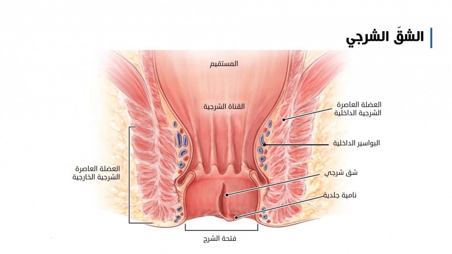 الشرخ الشرجي