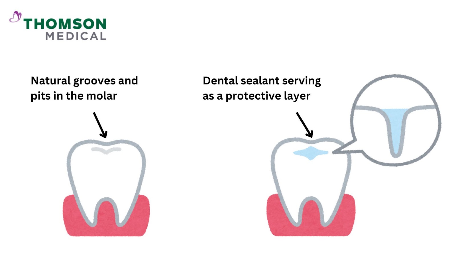 Dental sealant function