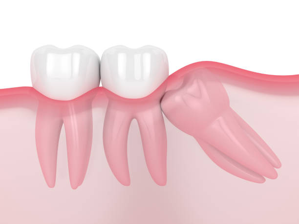 A diagram depicting the growth of wisdom teeth, showing how they can cause pain and discomfort as they emerge.