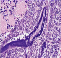 Small Cell Carcinoma