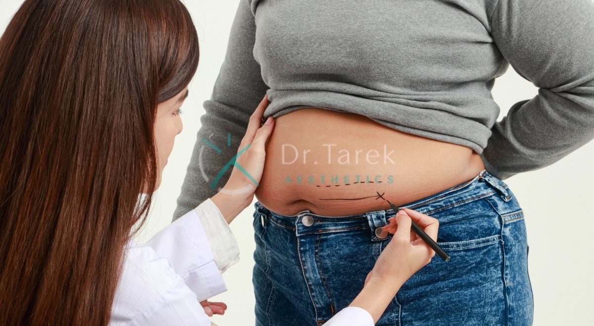 Where Does Fat Go After Liposuction 4 Dr. Tarek Aesthetics | Best Plastic Surgeon In Dubai Where Does Fat Go After Liposuction