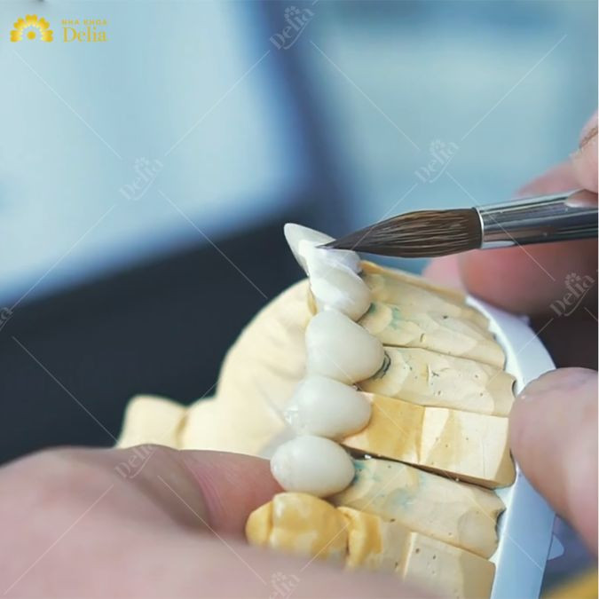 Phôi sứ Zirconia: Là loại phôi sứ được sử dụng phổ biến nhất hiện nay