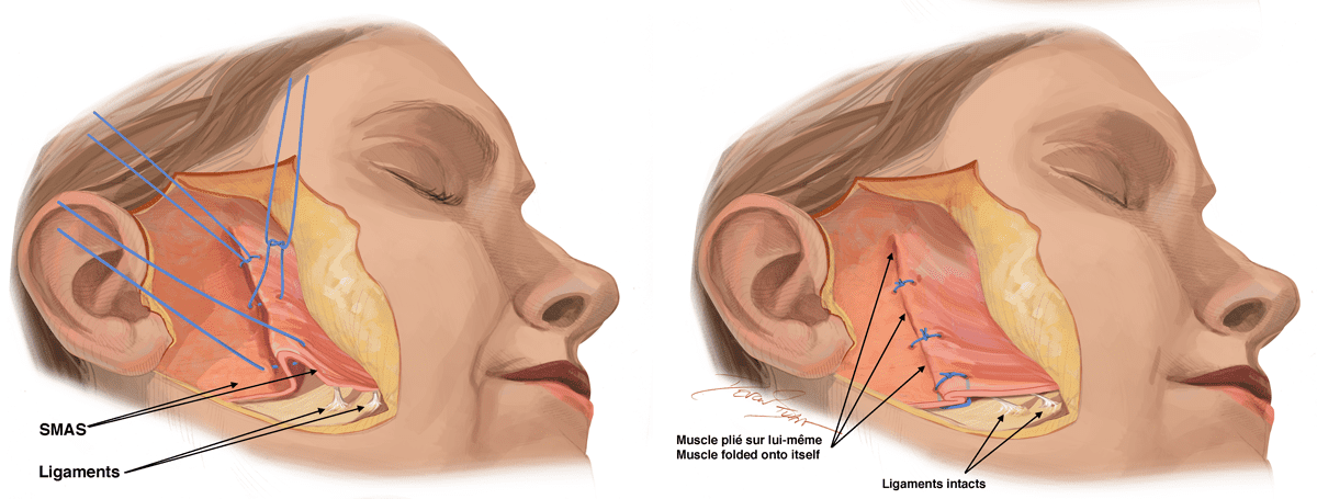 this image show the procedure of facelift treatment by https://renewyou.co.in/