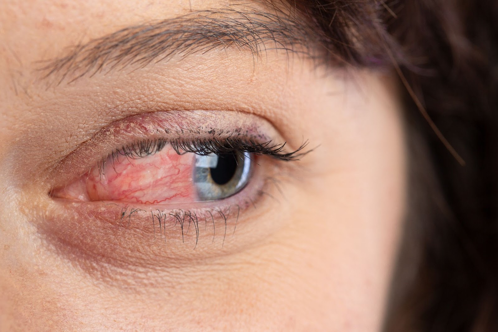 A close-up of the eye of someone suffering from ocular rosacea.