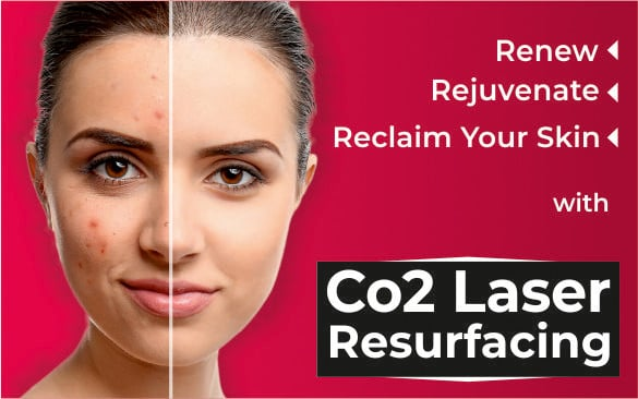 in this image the difference after the fractional Co2 laser treatment.