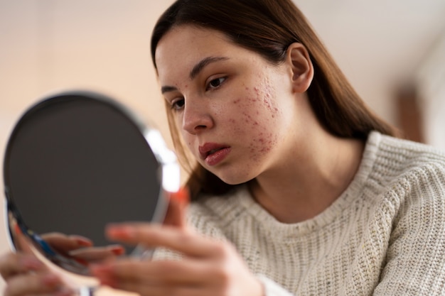 How Skin Vitamins Can Help With Acne and Breakouts