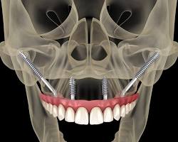 Image of Zygomatic Implant Procedure