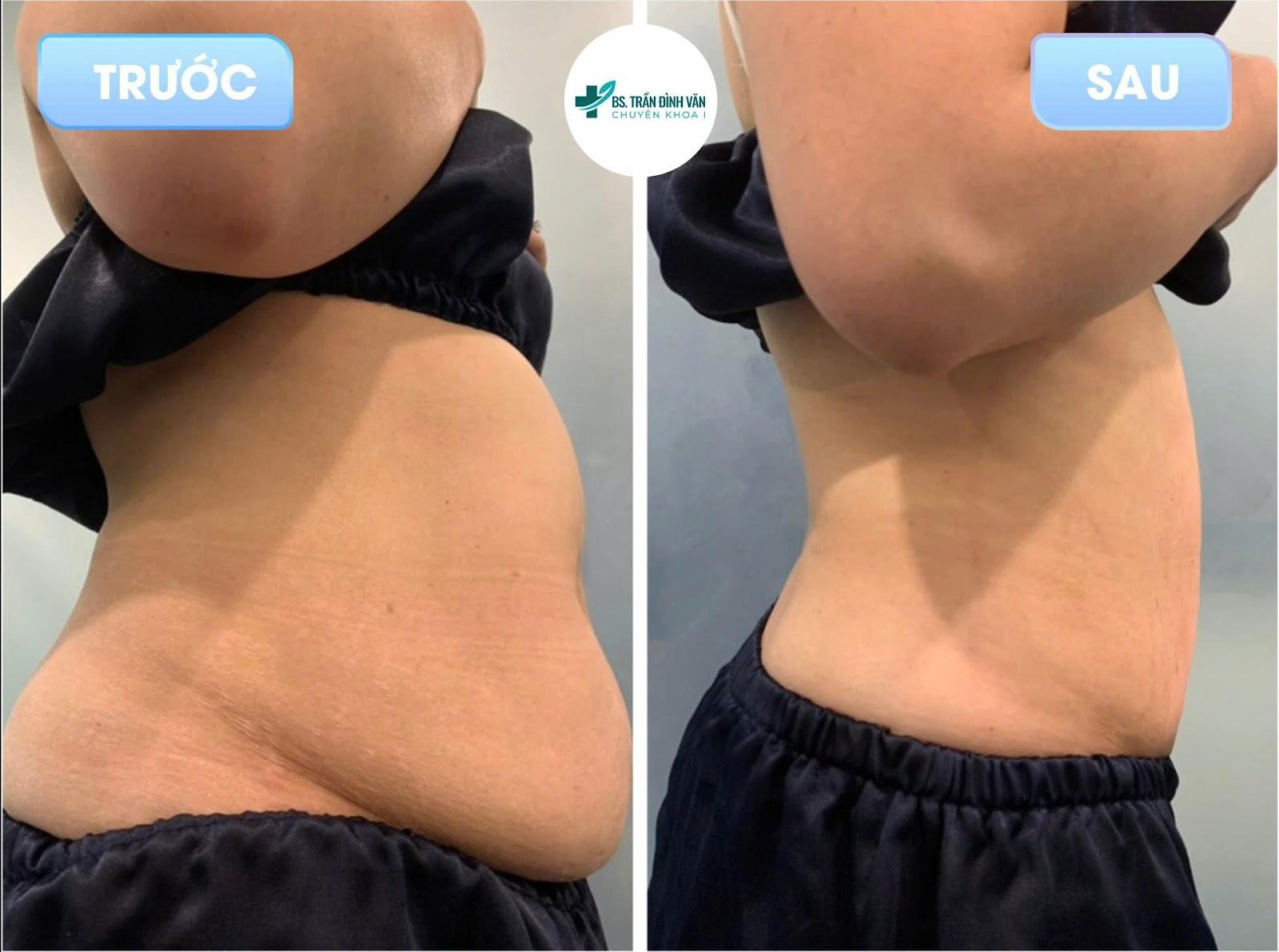 A person's stomach with a fat bellyAI-generated content may be incorrect.