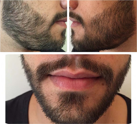 transplante de barba