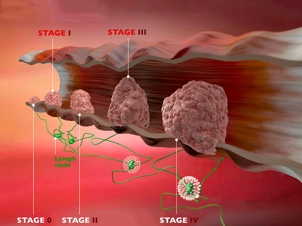 مراحل سرطان روده