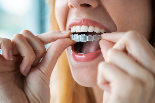 Invisalign Los Angeles | Your way to a perfect smile