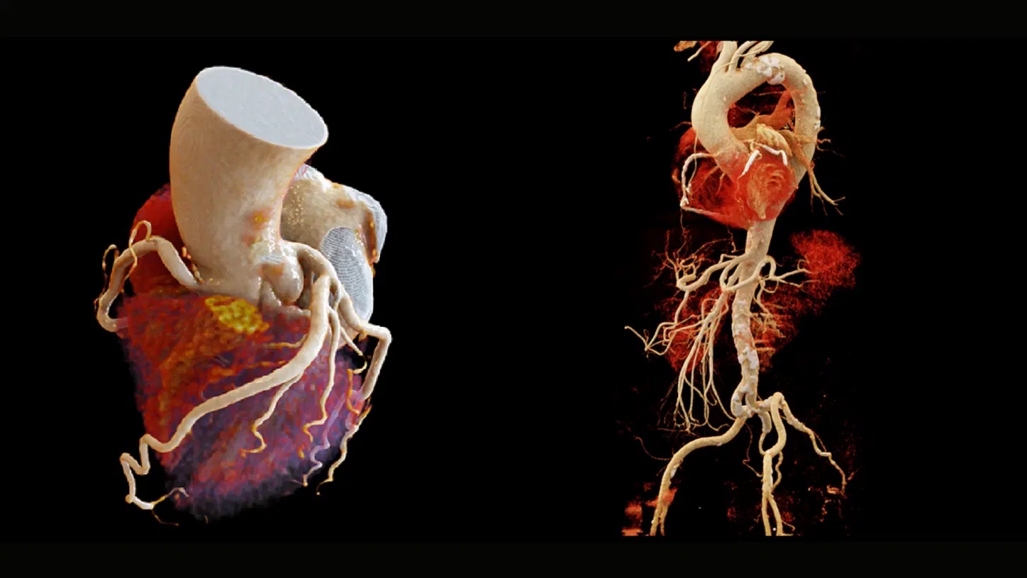 Cardiac CT Scans and MRI
