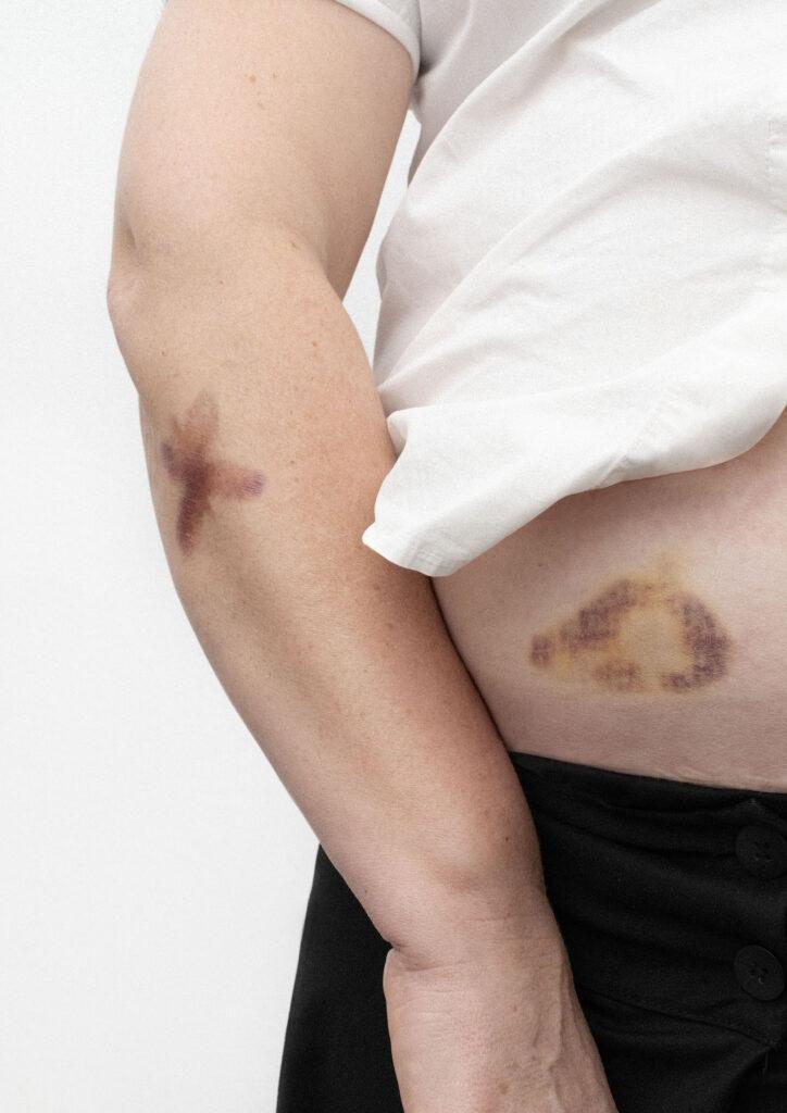 a_lielpetere_VWD_bruise_photos_6