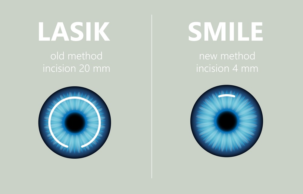 Lasik in delhi - with normal sugery