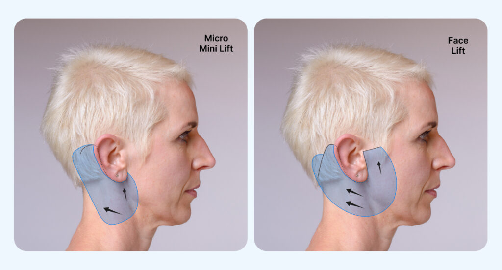 In this image the method of face lift are shown on the lady face by https://renewyou.co.in/