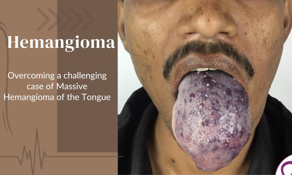 Problematic Hemangioma