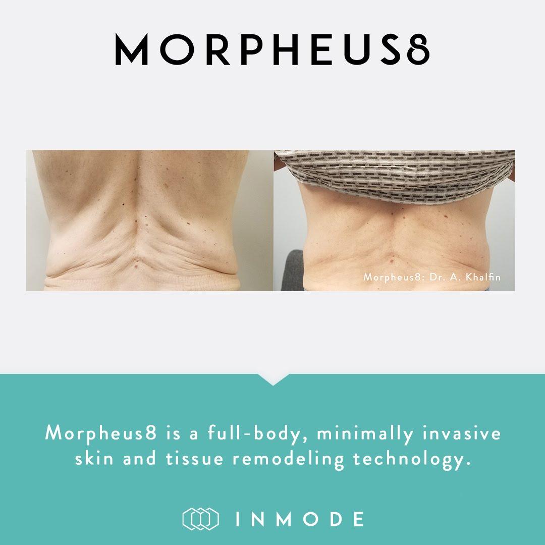 Microneedling in Nashville | Morpheus8