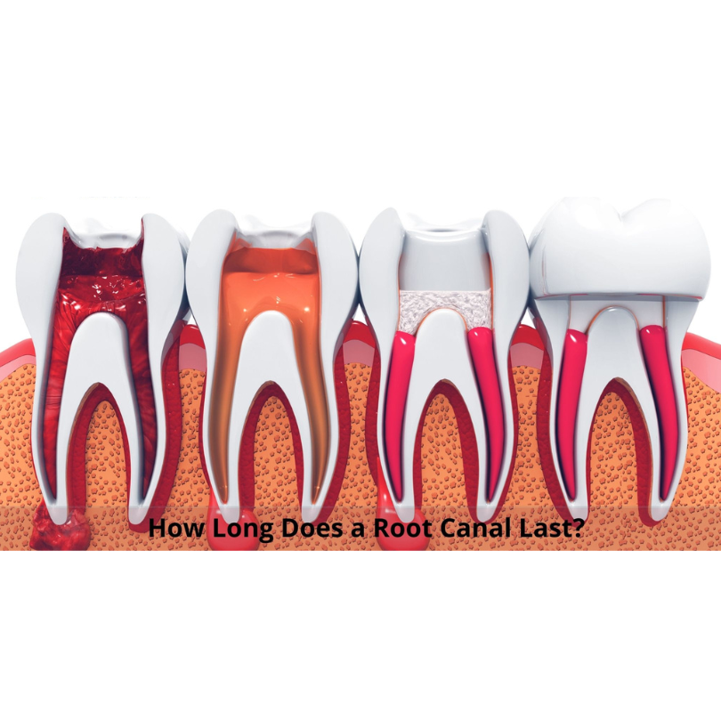 root canal life expectancy