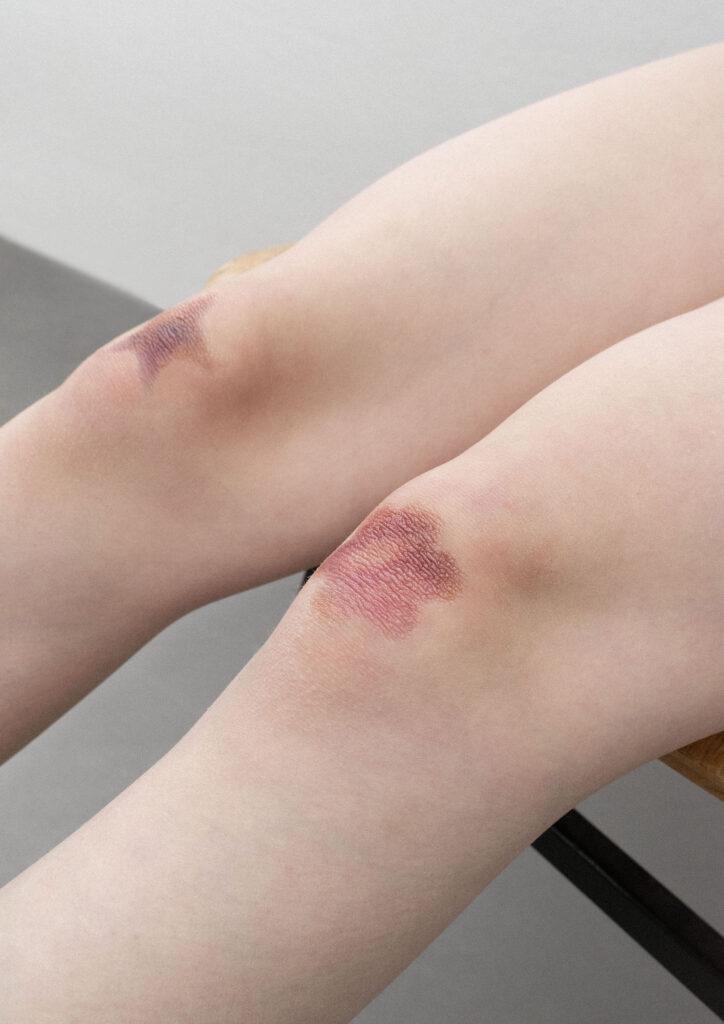 a_lielpetere_VWD_bruise_photos_5