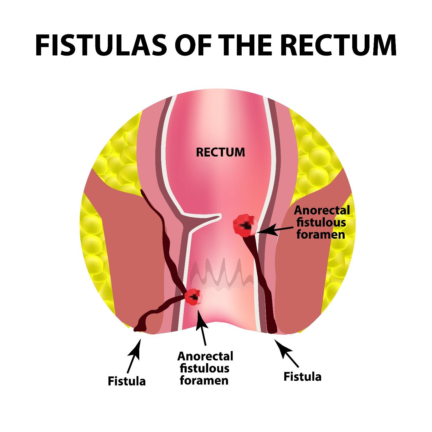 A diagram of a fistula

AI-generated content may be incorrect.