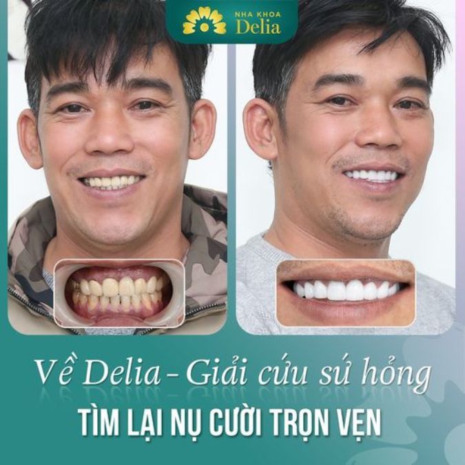 Delia là nơi đã thực hiện thành công hàng chục nghìn ca bọc răng sứ