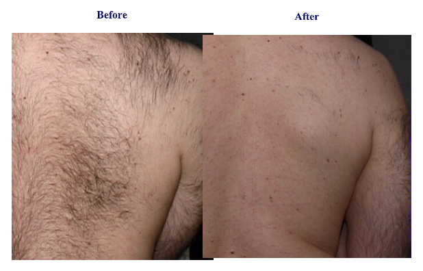 Unwanted Hair on Male Back