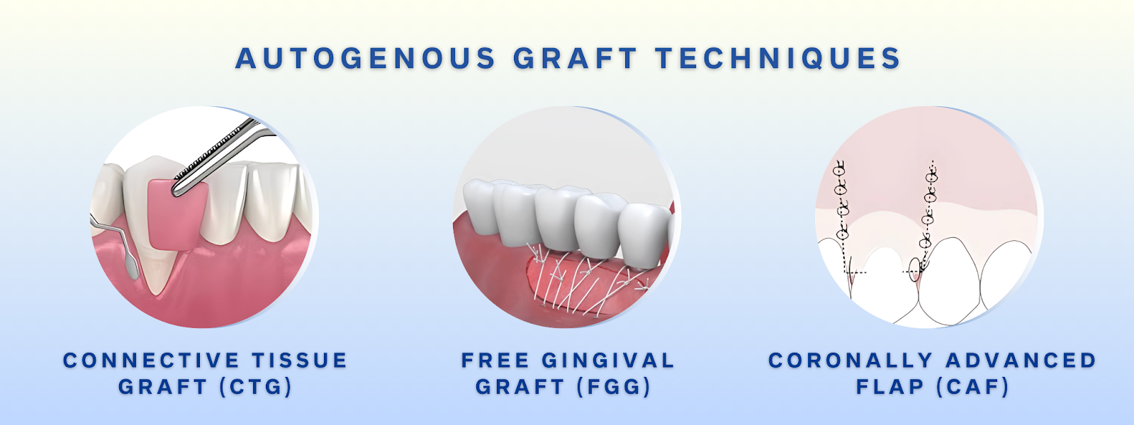 Mr. Bur Soft Tissue Trimming Bur supports autogenous graft procedures such as CTG, FGG, and CAF by enabling precise epithelial removal, flap contouring, and blood coagulation for optimal healing.