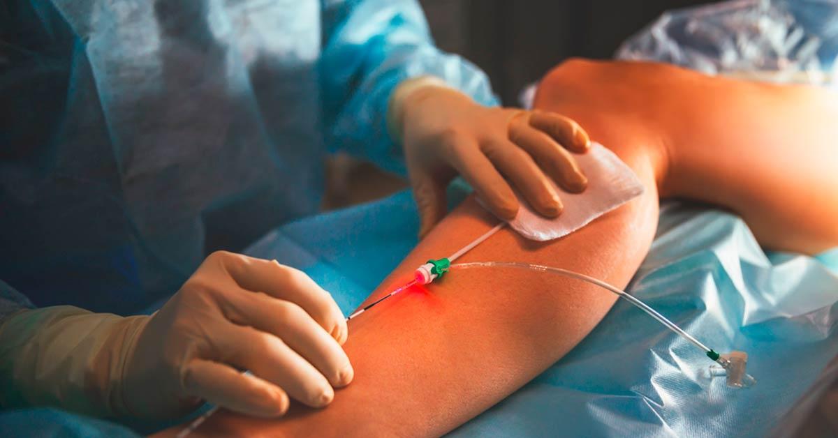 Conheça 4 procedimentos comuns nas cirurgias vasculares