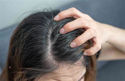 ACV relieves itchy and dandruff scalp