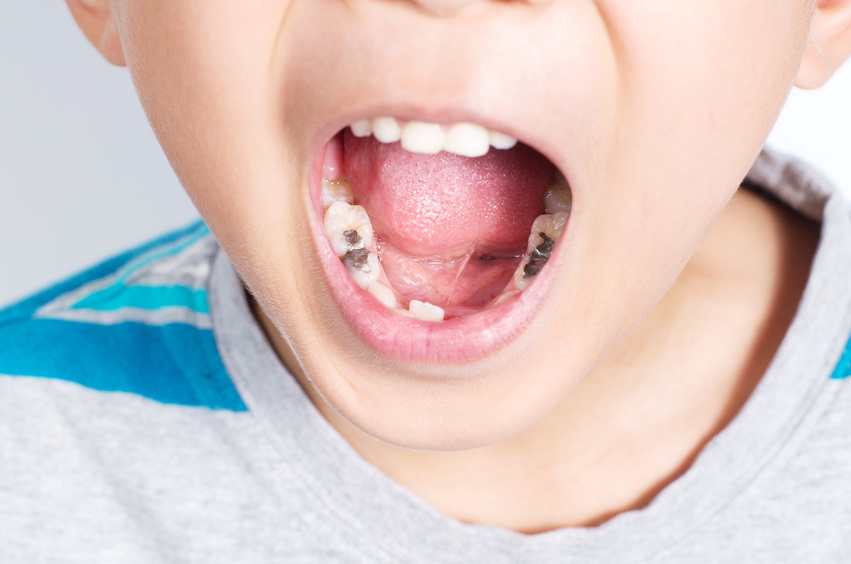 Tooth Decay