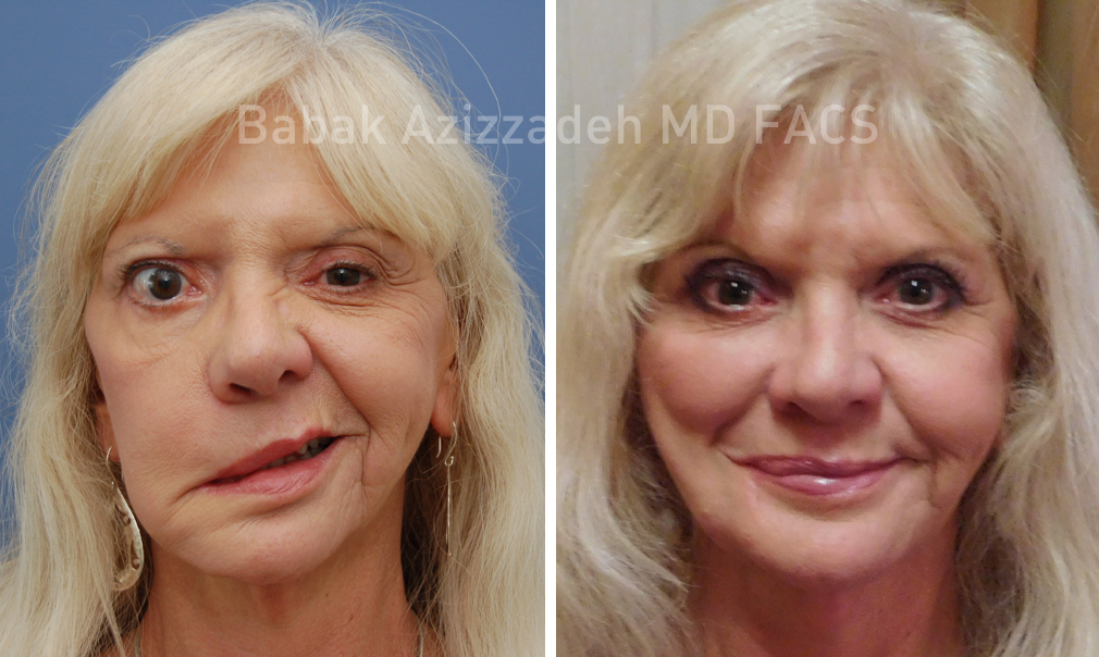 Masseter to Trigeminal Facial Nerve Transfer