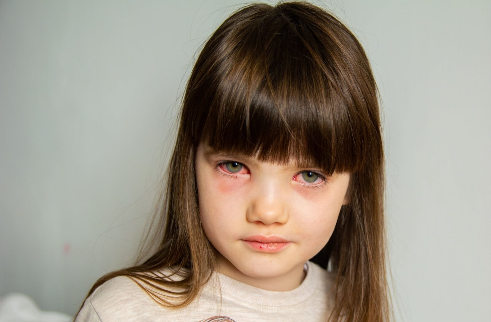 A young child with conjunctivitis making the whites of their eyes bloodshot and the bags under their eyes bruised.