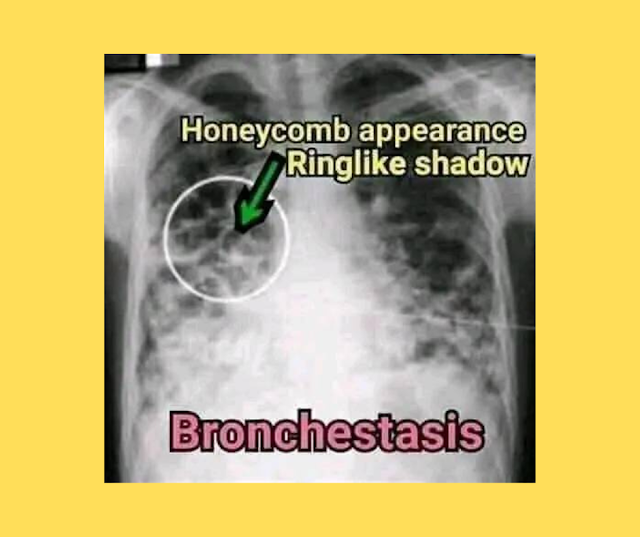 What is Bronchiectasis? 