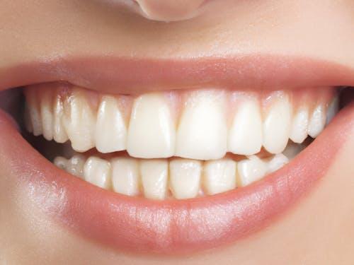 Free Beautiful Gummy Smile with White Teeth  Stock Photo