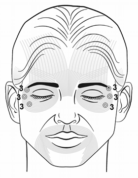 Botox Training Orbicularis Oculi Injection Pattern