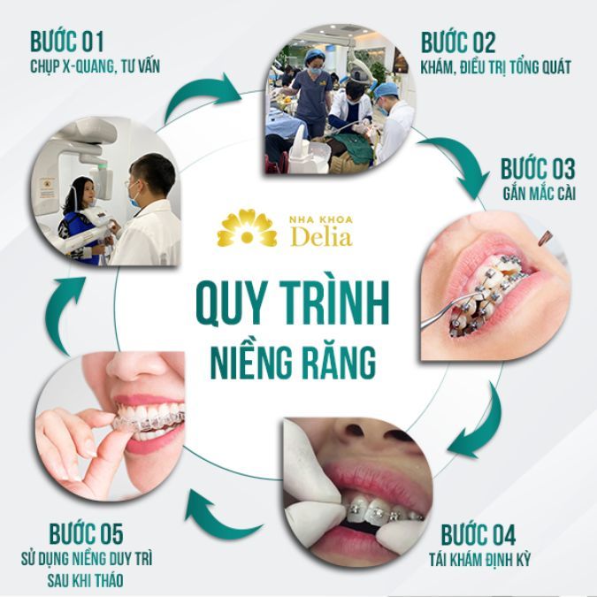 5 bước niềng răng hô mắc cài