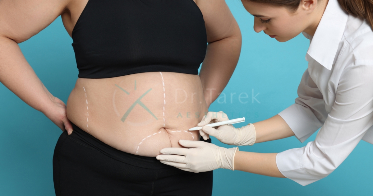 Are Liposuction Results Immediate