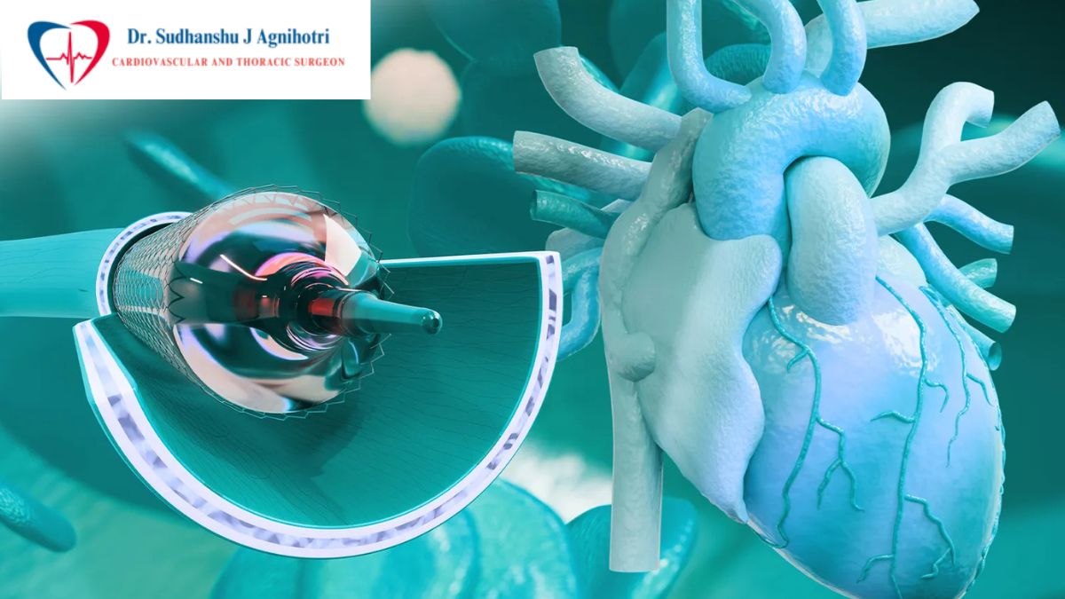 Heart Bypass Surgery - Dr Sudhanshu J Agnihotri - Best Cardiac Surgeon In Indore