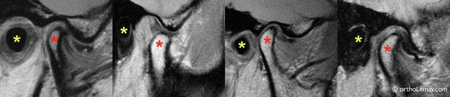 https://www.orthodontisteenligne.com/wp-content/uploads/2011/03/ATM-IRM-TMJ-MRI-articulation-orthodontie-sherbrooke.jpg