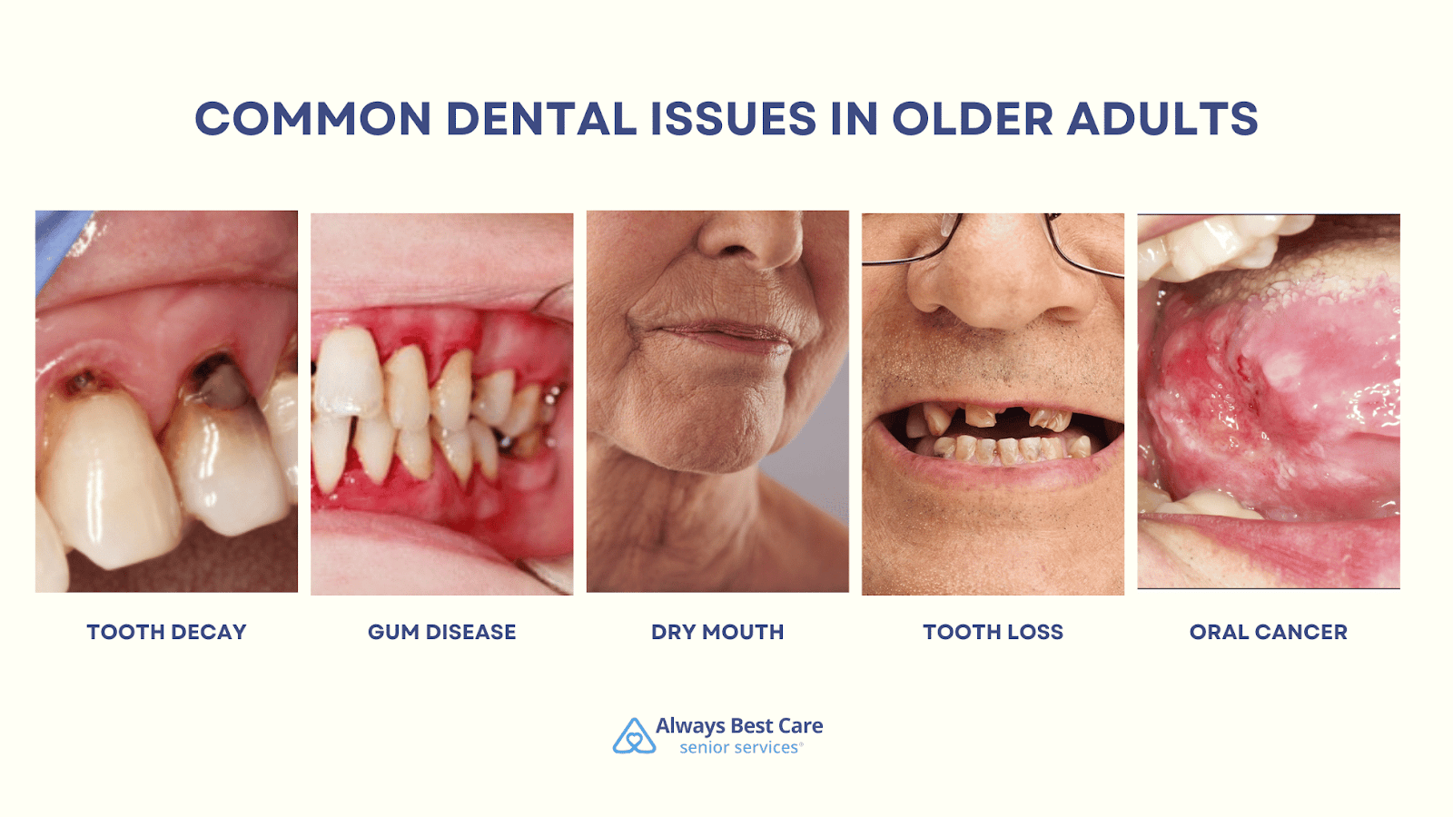 This is an infographic detailing the 5 common oral health problems in seniors